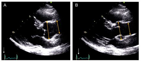 accendink lv|THE AMERICAN SOCIETY OF ECHOCARDIOGRAPHY .